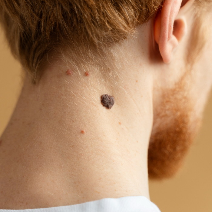 Mole Wart Corn and Skin Tags Removal